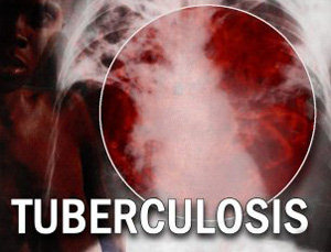 Novel method to quickly detect active TB in smear-negative patientsNovel method to quickly detect active TB in smear-negative patients