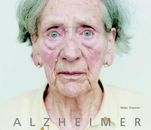 Soon, simple blood test to tell if a women is at Alzheimer''s risk