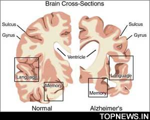  Ulcer drugs with ibuprofen may offer Alzheimer''s treatment