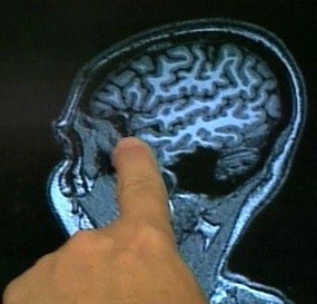 Alzheimer identified