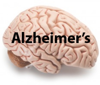 Alzheimer