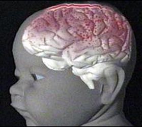 Special vitamin supplement could prevent baby brain disorder