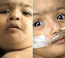 Oz docs separate conjoined twins after 27hr long surgery
