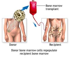 Bone marrow transplants: Trichotillomania healing