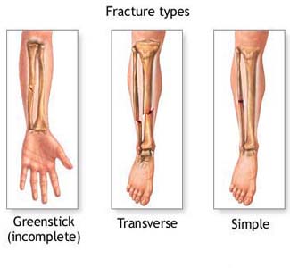 Thigh Bone Fracture