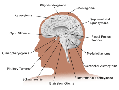 Killer cocktail fights brain cancer