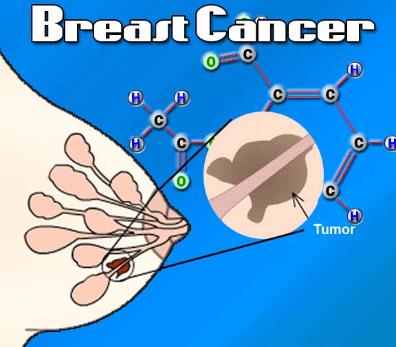 Breast-Cancer
