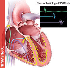 Study: Highest Risk of Sudden Cardiac Death within 30 Days post Heart Attack