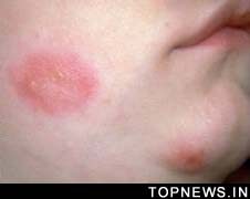 Cellular process to fight herpes virus identified