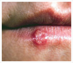 Faulty immune memory can trigger cold sores, cancer