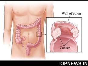 Hormone therapy may protect women from colorectal cancer