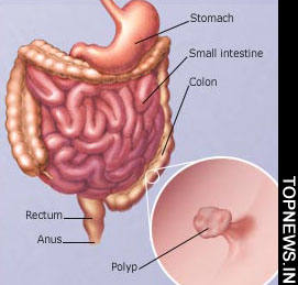 The five lifestyle changes that can cut colorectal cancer risk by a third