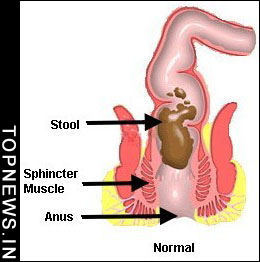 Coming soon, a sureshot way to treat constipation