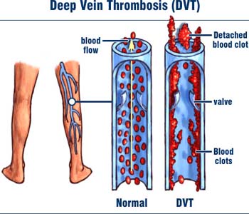 Deep-vein thrombosis claiming more lives than breast cancer and AIDS combined