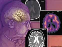 Women who store waist fat likely to develop dementia