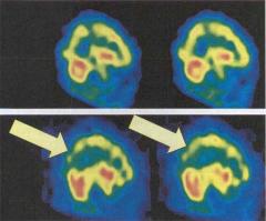 Surfing the net ''can help older adults slow dementia''