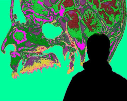 Midlife hypertension linked to greater dementia risk 