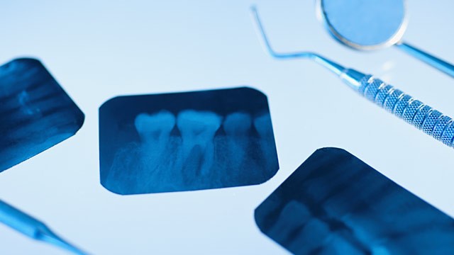 Frequent dental X-rays increase risk of brain tumours, study