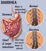 Little progress in implementation of lifesaving diarrhea treatments for kids