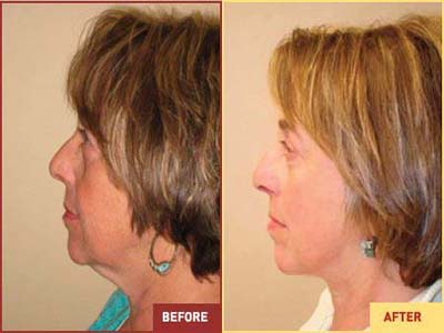 Future approach to facial rejuvenation may have restoring structure underneath as its first step