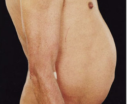 Fatty deposits ‘can harm heart function’