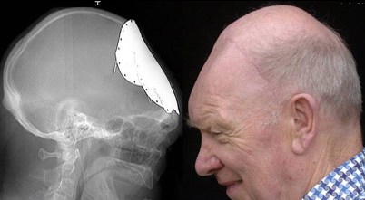 Brit septuagenarian grows new skull, 50 years after car crash