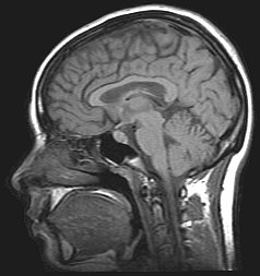 HRT-Alzheimer