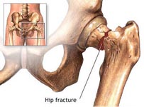 Three-pronged approach to osteoporosis can reduce hip fractures