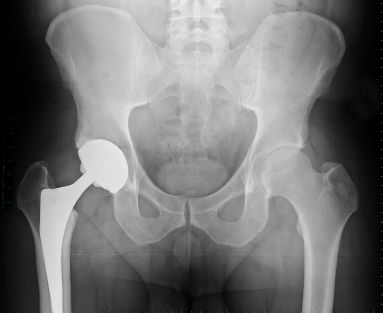 Hip replacement facility available at Hyderabad hospital