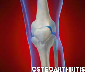 Moderate weight loss could trim risk of osteoarthritis in the knee