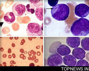 Common infections may trigger leukaemia