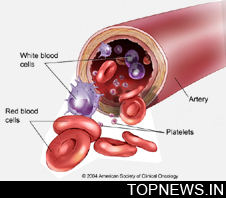 New biomarker that may help predict leukemia aggressiveness identified