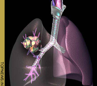 Genetic mutations may stunt kids’ lung development