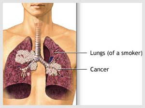 Turning off oncogene may inhibit lung cancer stem cells'' growth