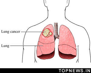 High-dose radiation, chemo combo boosts survival in lung cancer patients