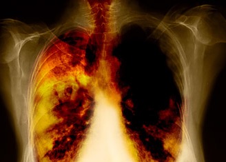 Experts concerned over rising Lung Cancer Rate among women