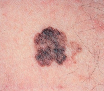 New approach to slower the growth of Melanoma