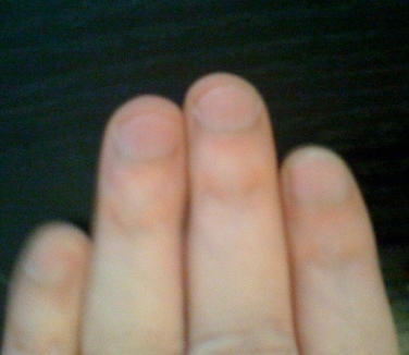 Men with long ring finger likely to suffer from prostate cancer