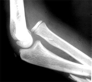 Promising new path for treating traumatic injuries discovered