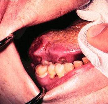 Mouth-Cancer