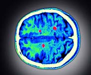 Multiple sclerosis more aggressive in children