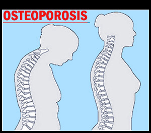 NICE rules keep women away from better osteoporosis