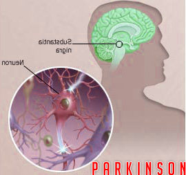 Higher urate levels slow the progression of Parskinson''s disease