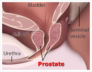 Boffins find link between common sexual infection, prostate cancer risk