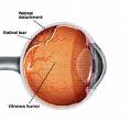 Retinal Detachment