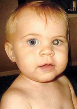 Retinoblastoma