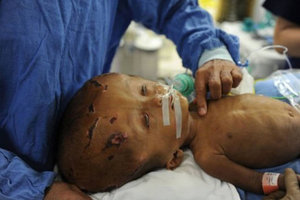 Doctors conduct reconstructive surgery on baby’s skull