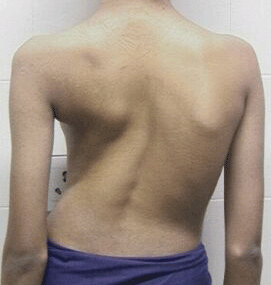 Scoliosis cure provides youthful patients expectations
