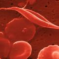 Marrow Transplants Hold Cure for Sickle Cell