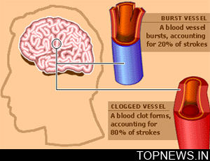 Stroke patient becomes first to be treated with his own stem cells